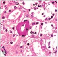 <strong>In this high power photomicrograph of a renal arteriole from a diabetic patient,the area of the image labelled H depicts which one of the following pathologic processes?  </strong> A)Atrophy B)Hyaline change C)Infarction of the vessel wall D)Thrombosis <div style=padding-top: 35px> 