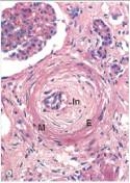 <strong>This high power photomicrograph of a medium sized artery in a patient with severe hypertension depicts a serious condition that is known by which one of the following words or phrases?  </strong> A)Glomerulosclerosis B)Hyaline arteriolosclerosis C)Intimal proliferation D)Malignant hypertension <div style=padding-top: 35px> 