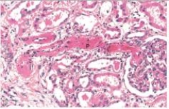 <strong>This high power photomicrograph of a renal arteriole in a patient with severe hypertension depicts a serious condition that is known by which one of the following words or phrases?  </strong> A)Atrophy B)Fibrinoid necrosis C)Hyaline arteriolosclerosis D)Renal infarction <div style=padding-top: 35px> 