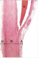 <strong>The low power photomicrograph of the aorta demonstrates a pathologic condition that is usually related to which one of the following disorders?  </strong> A)Diabetes B)Fever C)Hypertension D)Shock <div style=padding-top: 35px> 