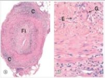 <strong>A 54 year old man presented to his primary care physician complaining of headache.A tortuous artery,which was indurated and tender to touch,was noted on his forehead.A representative section of a biopsy of this artery is shown in the accompanying photomicrograph,in low and high power.Which one of the following is the best diagnosis?  </strong> A)Atherosclerosis B)Giant cell arteritis C)Polyarteritis nodosa D)Thromboembolism E)Tuberculosis <div style=padding-top: 35px> 
