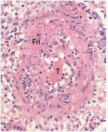 <strong>A 38 year old female was seen for fever of unknown origin (FUO).In addition to fever,she was experiencing abdominal pain.Finally,it was decided that an appendicectomy was required,as her pain seemed to favour the right lower quadrant.The appendix was essentially normal microscopically,but a small artery in the fat surrounding the appendix demonstrated the findings seen in the accompanying photomicrograph.Which one of the following is the best diagnosis?  </strong> A)Acute appendicitis B)Acute inflammation C)Chronic inflammation D)Polyarteritis nodosa <div style=padding-top: 35px> 