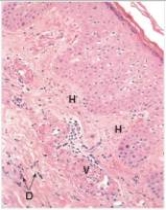 <strong>A 16 year old female was given penicillin for an apparent Strep throat.She soon developed a reddish-appearing skin rash,which was firm when palpated.A biopsy was performed.A representative section of the biopsy is shown in the accompanying photomicrograph.Which one of the following is the best diagnosis?  </strong> A)Angiosarcoma B)Giant cell arteritis C)Glomus tumour D)Haemangioma E)Kaposi's sarcoma F)Leukocytoclastic vasculitis (microscopic polyarteritis) G)Polyarteritis nodosa <div style=padding-top: 35px> 