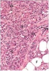 <strong>A 30 year old male homosexual,who was HIV-positive,presented to his primary care physician complaining of a rash on his arm.He had not been taking his anti-retroviral drugs,due to the side effects.Numerous,slightly raised,purple lesions were noted on the patient's forearm by the examining physician.A biopsy of one of the nodules was performed.A representative section of the biopsy is shown in the accompanying photomicrograph.Which one of the following is the most likely diagnosis?  </strong> A)Angiosarcoma B)Giant cell arteritis C)Glomus tumour D)Haemangioma E)Kaposi's sarcoma F)Leukocytoclastic vasculitis (microscopic polyarteritis) G)Polyarteritis nodosa <div style=padding-top: 35px> 