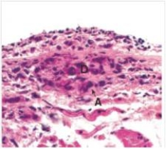 <strong>A 15 year old girl developed fever,aching joints,and a heart murmur.Her past medical history was negative,except for a Strep throat approximately 6 weeks prior,for which she did not seek treatment.An endomyocardial biopsy was performed,via the external jugular vein,a representative section of which is shown in the accompanying photomicrograph.Which one of the following best describes the pathology seen in the biopsy?  </strong> A)Acute inflammation B)Aschoff nodule C)Chronic inflammation D)Rheumatoid nodule E)Rheumatic fever <div style=padding-top: 35px> 