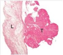 <strong>A 67 year old man,with a known history of inoperable pancreatic adenocarcinoma,suddenly developed symptoms of a massive stroke,losing the ability to walk.He subsequently died from cerebral oedema,and the family requested an autopsy.In the accompanying low power photomicrograph of a mitral valve leaflet (L),the thrombus (T)attached to the leaflet was probably caused by which one of the following pathophysiologic conditions?  </strong> A)Anaemia B)Biliary obstruction by tumour C)Diabetes mellitus D)Fever E)Hypercoagulable state A.Shock <div style=padding-top: 35px> 