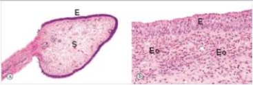 <strong>A 23 year old woman was seen by her primary care physician for a nasal obstruction.A polyp was seen and removed.A representative section is shown in the accompanying photomicrograph.From the histological appearance,which one of the following aetiological events is likely in this case? </strong> A)Allergic sinusitis B)Bacterial sinusitis C)Neoplasm due to smoking D)Parasitic infection E)Viral sinusitis
