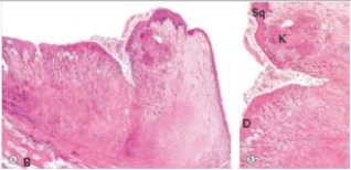 <strong>A 58-year-old white male with a 40 pack year smoking history presented to his local physician complaining of hoarseness for over one month.Laryngoscopy revealed an invasive tumour.A total laryngectomy was then performed,a representative section of which is shown in the accompanying photomicrograph.Which one of the following is the best diagnosis? </strong> A)Adenocarcinoma B)Condyloma acuminatum C)Squamous cell carcinoma D)Squamous papilloma E)Transitional cell carcinoma