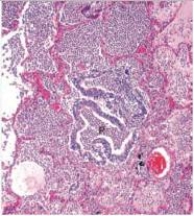<strong>An otherwise well 68 year old woman presents at the Emergency Department with fever and shortness of breath.A chest-x-ray shows patchy lung infiltrates bilaterally.A pneumonologist is consulted,who then performs a bronchoscopic biopsy,a representative section of which is shown in the accompanying photomicrograph.Which one of the following is the best diagnosis? </strong> A)Aspergillus pneumonia B)Bronchopneumonia C)CMV pneumonitis D)Lobar pneumonia E)Pneumocystis jirovecii pneumonia