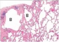 <strong>The accompanying photomicrograph shows a section of lung that had been resected from the right upper lobe of a 73 year old male who had smoked two packs of cigarettes a day since the age of 18.The inherent danger of bullae formation (B)in emphysema is the distinct possibility of which one of the following pathophysiologic events? </strong> A)Aspergillus infection B)Heart failure C)Lung cancer D)Pneumothorax E)Tuberculosis