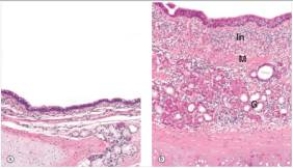 <strong>The accompanying photomicrograph compares normal bronchial mucosa (left)with abnormal mucosa (right).The magnification is approximately the same.Which one of the following is the best diagnosis for the tissue depicted on the right? </strong> A)Chronic bronchitis B)Emphysema C)Neoplasia (cancer) D)Pneumonia E)Tuberculosis