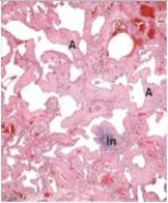 <strong>A 65 year old woman with a long history of smoking was found dead at home.An autopsy was requested by the family.They reported that she had recently been experiencing increasing breathlessness.A representative section from her lung is shown in the accompanying photomicrograph.Which one of the following is the best diagnosis? </strong> A)Adenocarcinoma of the lung B)Pulmonary oedema C)Pulmonary embolism D)Pulmonary fibrosis E)Pulmonary infarct