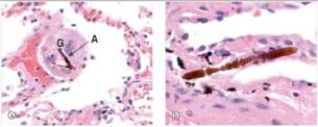 <strong>At autopsy of a 69 year old man,the lungs had the appearance shown in the accompanying photomicrographs.Which one of the following is the best diagnosis? </strong> A)Adenocarcinoma B)Asbestosis C)Chronic bronchitis D)Emphysema E)Silicosis