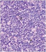 <strong>A 64 year old man with a 60 pack year smoking history was seen by his local physician for fatigue.He also reported having lost 20 pounds over the previous two months,while eating his normal diet.Chest x-ray disclosed a 4 cm mass near the left lung hilum.An endoscopic biopsy was performed,a representative section of which is shown in the accompanying photomicrograph.Which one of the following is the best diagnosis? </strong> A)Adenocarcinoma B)Bronchioloalveolar carcinoma C)Carcinoid tumour D)Large cell undifferentiated carcinoma E)Small cell carcinoma F)Squamous cell carcinoma
