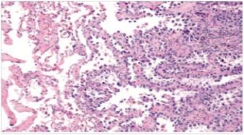 <strong>A 53 year old woman with a 40 pack year smoking history consulted her physician for a chronic cough.A chest x-ray disclosed an infiltrate in the right middle lobe.She was treated with two courses of antibiotics,but six weeks later,the infiltrate had not improved.A bronchoscopic biopsy was performed,a representative section of which is shown in the accompanying photomicrograph.Which one of the following is the best diagnosis? </strong> A)Adenocarcinoma B)Bronchioloalveolar carcinoma C)Carcinoid tumour D)Large cell undifferentiated carcinoma E)Small cell carcinoma F)Squamous cell carcinoma