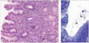 <strong>A 26 year old medical student reported epigastric pain and discomfort,often around exam time.Upper GI endoscopy was performed,which reveal oedematous,reddish gastric mucosa.A biopsy was done,a representative section of which is shown in the accompanying photomicrograph.The right panel shows a Cresyl violet special stain.Which one of the following is the best diagnosis?  </strong> A)Gastric adenocarcinoma B)Giardia lamblia C)Helicobacter pylori gastritis D)Peptic ulcer E)Psychosomatic tummy ache <div style=padding-top: 35px> 