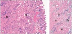<strong>A 48 year old Japanese man who had recently immigrated to the United States was seen by his local physician for fatigue,weight loss,and feeling full all the time.Endoscopy revealed a polypoid tumour mass with heaped up edges.A biopsy was performed,and a representative section is shown in the accompanying photomicrograph.Which one of the following is the best diagnosis?  </strong> A)Gastric adenocarcinoma B)Giardia lamblia C)Helicobacter pylori gastritis D)Peptic ulcer E)Signet ring carcinoma <div style=padding-top: 35px> 