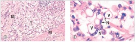 <strong>A 48 year old Japanese man who had recently immigrated to the United States was seen by his local physician for fatigue,weight loss,and feeling full all the time.Endoscopy revealed an absence of rugal folds,and the stomach was difficult to distend with air,so-called leather bottle stomach.A biopsy was performed,and a representative section is shown in the accompanying photomicrograph.Which one of the following is the best diagnosis?  </strong> A)Amoebiasis B)Gastric carcinoma C)Granulomatous inflammation D)Peptic ulcer E)Signet ring cell gastric carcinoma,diffuse type <div style=padding-top: 35px> 