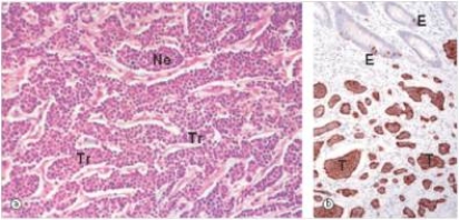 <strong>A 38 year old male consulted his local physician because he was experiencing strange episodes of skin flushing and sweating.The physician suspected a GI tumour,and ordered a CT scan,which disclosed a mass in the duodenum,and possible metastatic disease in the liver.The duodenal mass was biopsied,and is shown in the accompanying high power photomicrograph.An immunohistochemistry stain for chromogranin is shown on the right.Which one of the following is the best diagnosis?  </strong> A)Adenocarcinoma B)Carcinoid tumour C)Small cell carcinoma D)Pancreatic carcinoma E)Transitional cell carcinoma <div style=padding-top: 35px> 