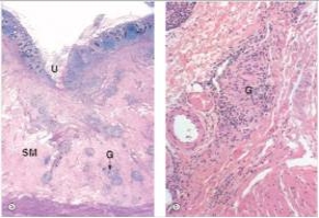 <strong>A 25 year old woman woke one morning feeling something wet and warm on her abdomen.When she pulled back the covers,she discovered it was liquid faeces,leaking from a fistulous opening on her abdominal wall,which was soon discovered to have originated in her ileum.She recounted that she had been experiencing diarrhoea for several weeks prior to this event,but had not sought medical attention.At the hospital,a section of small bowel was resected,and the fistula repaired.A representative section of the surgical specimen is shown in the accompanying photomicrograph,with a high power view on the right.Which one of the following is the best diagnosis?  </strong> A)Adenocarcinoma B)Crohn's disease C)Peptic ulcer D)Tuberculosis E)Ulcerative colitis <div style=padding-top: 35px> 