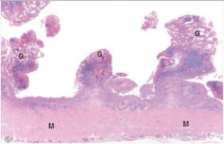 <strong>A 35 year old mechanic was experiencing excruciating bouts of bloody diarrhoea.He consulted his local physician,who recommended partial colectomy in order to control the bleeding.A representative section of the specimen is shown in the accompanying low power photomicrograph.Which one of the following is the most likely diagnosis?  </strong> A)Adenocarcinoma B)Crohn's disease C)Giardia lamblia D)Peptic ulcer disease E)Ulcerative colitis <div style=padding-top: 35px> 