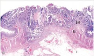 <strong>A 48 year old man became alarmed when he noted some bright red blood in his stool.He consulted a local physician,who palpated an indurated area (firm to touch)in the patient's rectum.Surgery was performed,and a representative section of the surgical specimen is show on low power in the accompanying photomicrograph.Which one of the following is the best diagnosis?  </strong> A)Adenomatous polyp B)Invasive adenocarcinoma C)Tubulovillous adenoma D)Ulcerative colitis E)Villous adenoma <div style=padding-top: 35px> 