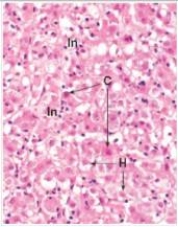<strong>A 22 year old woman returned to the United States from a trip to Mexico.She suddenly became ill,with nausea and vomiting.She underwent a needle biopsy of the liver.Later,serology was found to be positive for hepatitis A virus.A representative section of her liver biopsy is shown in the accompanying photomicrograph.Which one of the following interpretations of the eosinophilic bodies denoted by the arrows marked C is most likely CORRECT?  </strong> A)Acute inflammatory cells B)Apoptotic bodies C)Bile ducts D)Chronic inflammatory cells E)Mallory's (alcoholic)hyaline F)Viral inclusion bodies <div style=padding-top: 35px> 