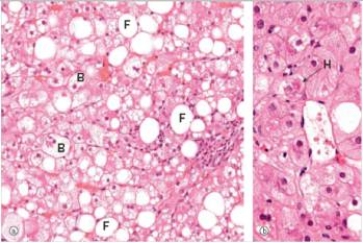 <strong>A 50 year old man was brought to the Emergency Department in a stupor by police.A history was unobtainable.An initial workup disclosed jaundice,elevated liver function tests,and a blood alcohol of 300 mg/dL (the legal limit is 80 mg/dL).In order to ascertain the extent of his liver problem,a needle biopsy of the liver was performed.A representative section of the biopsy is shown in the accompanying photomicrograph.Which one of the following is the most likely composition of the eosinophilic cytoplasmic substance labelled H in the high power view of the biopsy shown on the right?  </strong> A)Collagen B)Cytokeratin C)Fibrin D)Hyaline E)Vimentin <div style=padding-top: 35px> 