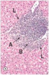 <strong>A 24 year old man returned from his trip to China only to find himself feeling fatigued,with night sweats.He had an acute bout of hepatitis B in China,but thought he had recovered.A liver biopsy was performed.A representative section is shown in the accompanying photomicrograph.Which one of the following is the best diagnosis?  </strong> A)Alcoholic hepatitis B)Chronic hepatitis,low grade C)Cirrhosis D)Lobular hepatitis E)Normal liver histology <div style=padding-top: 35px> 