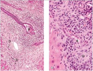 <strong>A 47 year old woman presented to her local physician with complaints of nausea and fatigue.She appeared somewhat jaundiced,which was confirmed by serum tests,which showed elevated liver function tests and increased indirect bilirubin.A liver biopsy was performed.A representative section is shown in low and high power in the accompanying photomicrograph.Which one of the following is the best diagnosis?  </strong> A)Alcoholic hepatitis B)Ascending cholangitis C)Cirrhosis D)Chronic hepatitis E)Primary biliary cirrhosis <div style=padding-top: 35px> 