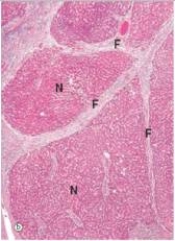 <strong>A 54 year old homeless male was brought to the Emergency Department vomiting blood.After he was stabilised,a physical exam revealed a hard,nodular liver.A biopsy was later performed,a representative section of which is shown in the accompanying photomicrograph.Which one of the following is the best diagnosis?  </strong> A)Acute hepatitis B)Cirrhosis C)Haemochromatosis D)Hepatocellular carcinoma E)Metastatic carcinoma <div style=padding-top: 35px> 