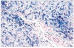 <strong>A 39 year old male was seen by his local physician for fatigue.Previously,the man had engaged in numerous sports activities,and appeared fit and well-tanned.Routine labs revealed an elevated blood sugar and an elevated liver function test.A liver biopsy was obtained,and a representative section (Perls' stain)is shown in the accompanying photomicrograph.Which one of the following is the best diagnosis?  </strong> A)Acute hepatitis B)Cirrhosis C)Haemochromatosis D)Hepatocellular carcinoma E)Metastatic carcinoma <div style=padding-top: 35px> 