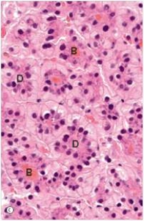<strong>A 54 year old man with alcoholic cirrhosis was seen by a local physician for steadily worsening encephalopathy and ascites.A CT scan disclosed a distinct mass within his scarred liver.A needle biopsy was obtained,a representative section of which is shown in the accompanying photomicrograph.Which one of the following is the best diagnosis?  </strong> A)Alcoholic hepatitis B)Hepatocellular carcinoma C)Metastatic carcinoma D)Normal liver histology E)Primary biliary cirrhosis <div style=padding-top: 35px> 
