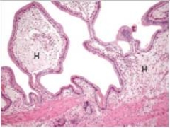 <strong>An obese,40 year old mother of four complained of nausea,diarrhoea,and foul-smelling stools.Physical examination revealed tenderness in the right upper quadrant.A laparoscopic cholecystectomy was then scheduled and later performed.The gross specimen showed flecks of yellow on the red,inflamed mucosa of the gall bladder.A representative section is shown in the accompanying photomicrograph.Which one of the following is the best diagnosis?  </strong> A)Carcinoma of the gall bladder B)Gallstones (cholelithiasis) C)Granulomatous inflammation of the gall bladder D)Strawberry gall bladder E)Tuberculosis of the gall bladder <div style=padding-top: 35px> 