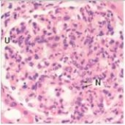 <strong>An 8 year old child was brought to his family physician because of fever,lethargy,and sudden weight gain.He had previously been well,except for a recent bout with strep throat.Upon physical examination,severe peripheral oedema (grade 3+)was noted.Urinalysis disclosed increased amounts of protein and RBCs.A renal biopsy was performed,a representative section of which is shown in the accompanying photomicrograph.Which one of the following is the best diagnosis?  </strong> A)Acute proliferative glomerulonephritis B)Diabetic glomerulosclerosis C)Focal segmental glomerulonephritis D)Membranous nephropathy E)Mesangiocapillary (Membranoproliferative)glomerulonephritis F)Minimal change disease G)Normal glomerulus H)Rapidly progressive glomerulonephritis (RPGN) <div style=padding-top: 35px> 