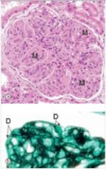 <strong>A 43 year old man with chronic hepatitis B was seen by a nephrologist,after his primary care physician initially diagnosed nephrotic syndrome.A renal biopsy way performed,a representative section of which is shown in the accompanying photomicrograph,including a high power silver stain of the glomerulus (bottom).Which one of the following is the best diagnosis?  </strong> A)Acute proliferative glomerulonephritis B)Diabetic glomerulosclerosis C)Focal segmental glomerulonephritis D)Membranous nephropathy E)Mesangiocapillary (Membranoproliferative)glomerulonephritis F)Minimal change disease G)Normal glomerulus H)Rapidly progressive glomerulonephritis (RPGN) <div style=padding-top: 35px> 