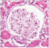 <strong>An 8 year old boy was seen by his family physician for sudden weight gain.Otherwise,he was completely well.Upon physical examination,the child had obvious severe peripheral oedema (grade 4+).Urinalysis showed a markedly increased protein level,but no RBCs.A few fat droplets were seen in the sediment.A renal biopsy was recommended,and the results are shown in the accompanying photomicrograph.The child eventually recovered completely after several doses of systemic corticosteroids.Which one of the following is the best diagnosis?  </strong> A)Acute proliferative glomerulonephritis B)Diabetic glomerulosclerosis C)Focal segmental glomerulonephritis D)Membranous nephropathy E)Mesangiocapillary (Membranoproliferative)glomerulonephritis F)Minimal change disease G)Normal glomerulus H)Rapidly progressive glomerulonephritis (RPGN) <div style=padding-top: 35px> 