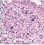 <strong>A 28 year old woman with a 7 year history of Systemic Lupus Erythematosus was experiencing increasing BUN and creatinine levels.Her physicians recommended a renal biopsy,a representative section of which is shown in the accompanying photomicrograph.Which one of the following is the best diagnosis?  </strong> A)Acute proliferative glomerulonephritis B)Diabetic glomerulosclerosis C)Focal segmental glomerulonephritis D)Membranous nephropathy E)Mesangiocapillary (Membranoproliferative)glomerulonephritis F)Minimal change disease G)Normal glomerulus H)Rapidly progressive glomerulonephritis (RPGN) <div style=padding-top: 35px> 