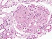 <strong>A 42 year old type I diabetic was experiencing increasing azotemia,as judged by his BUN and creatinine.His physician recommended he consult a nephrologist.A renal biopsy was recommended,and eventually performed,a representative section of which is shown in the accompanying photomicrograph.Which one of the following is the best diagnosis?  </strong> A)Acute proliferative glomerulonephritis B)Diabetic glomerulosclerosis C)Focal segmental glomerulonephritis D)Membranous nephropathy E)Mesangiocapillary (Membranoproliferative)glomerulonephritis F)Minimal change disease G)Normal glomerulus H)Rapidly progressive glomerulonephritis (RPGN) <div style=padding-top: 35px> 