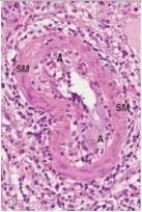 <strong>A 45 year old diabetic in chronic renal failure required kidney transplantation.A cadaveric donor was found,and a transplant was performed.After approximately 60 days,urine production from the transplanted kidney began to drop.A renal biopsy was obtained,and a representative section is shown in the accompanying photomicrograph.What type of inflammatory cell is involved in the etiology of the intimal arteritis (A)seen in the biopsy material?  </strong> A)B cell B)Endothelial cell C)Neutrophil D)Plasma cell E)T cell <div style=padding-top: 35px> 