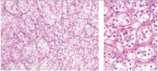 <strong>A 48 year old male seeks attention from his primary care physician because of pain in his right flank,blood in his urine,and what he thinks is a mass on his right side.The physician confirms the presence of a mass in the right flank,and refers the patient to a urologist,who removes a mass involving the right kidney.A representative section of the mass is shown in the accompanying photomicrograph.Which one of the following is the best diagnosis?  </strong> A)Adenocarcinoma B)Normal renal tubules C)Renal cell carcinoma D)Seminoma E)Transitional cell carcinoma <div style=padding-top: 35px> 