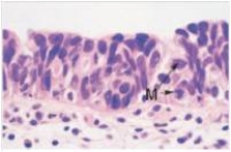 <strong>A 49 year old woman consulted her physician because of blood in her urine.She was referred to a urologist,who performed cystoscopy and bladder biopsy.A representative section of the biopsy is shown in the accompanying photomicrograph.Which one of the following is the best diagnosis?  </strong> A)Adenocarcinoma B)Invasive squamous cell carcinoma C)Invasive transitional cell carcinoma D)Papillary transitional cell carcinoma E)Transitional cell carcinoma in situ F)Urinary tract infection,chronic <div style=padding-top: 35px> 