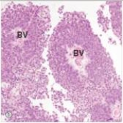 <strong>A 69 year old man consulted his physician because of blood in his urine.He was referred to a urologist,who performed cystoscopy and bladder biopsy.A representative section of the biopsy is shown in the accompanying photomicrograph.Which one of the following is the best diagnosis?  </strong> A)Adenocarcinoma B)Invasive squamous cell carcinoma C)Invasive transitional cell carcinoma D)Papillary transitional cell carcinoma E)Transitional cell carcinoma in situ F)Urinary tract infection,chronic <div style=padding-top: 35px> 