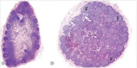 <strong>A 14 year old boy suffered from a splinter in his right finger,which became infected and inflamed.A large lymph node was found near his elbow,which his mother insisted must be removed.A representative section from the enlarged lymph node is shown at right in the accompanying photomicrograph,along with a normal lymph node that was removed at the same time.Which one of the following is the best diagnosis for the abnormal lymph node? </strong> A)Diffuse large B cell lymphoma B)Follicular hyperplasia C)Follicular lymphoma D)Hodgkin's lymphoma E)Metastatic carcinoma