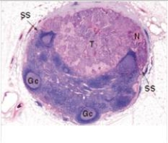 <strong>An enlarged mesenteric lymph node was removed from the abdomen of a 64 year old man at autopsy after he died in a motor vehicle accident.A representative section is shown in the accompanying photomicrograph.Which one of the following is the best diagnosis? </strong> A)Diffuse large B cell lymphoma B)Follicular hyperplasia C)Follicular lymphoma D)Hodgkin's lymphoma E)Metastatic carcinoma