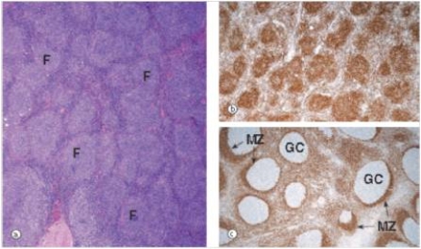 <strong>A 56 year old man noticed increased fatigue,night sweats,and enlarged lymph nodes in his right axilla.He consulted his physician,a biopsy was done,and a representative section from the biopsy is shown in the accompanying photomicrograph.The right panels show staining for Bcl-2,with a normal lymph node shown in the bottom panel (GC = germinal centre,MZ = mantle zone).Which one of the following is the best diagnosis? </strong> A)Diffuse large B cell lymphoma B)Follicular hyperplasia C)Follicular lymphoma D)Hodgkin's lymphoma E)Metastatic carcinoma