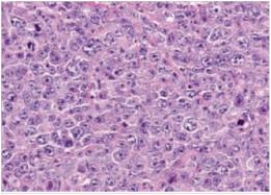 <strong>A 45 year old man with a previous history of untreated follicular lymphoma developed multiple lymph nodes that were enlarging quickly.Biopsy of one of these nodes was performed,and a representative section is shown in the accompanying photomicrograph.Which one of the following is the best diagnosis? </strong> A)Diffuse large B cell lymphoma B)Follicular hyperplasia C)Follicular lymphoma D)Hodgkin's lymphoma E)Metastatic carcinoma