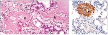 <strong>A 73 year old man complained to his physician about incapacitating back pain.An x-ray of the spine disclosed osteosclerotic lesions throughout the lumbar spine.A biopsy was performed,and a representative section is shown in photomicrograph a.Photomicrograph b shows an immunoperoxidase stain.Antibodies against which one of the following antigens was likely used in the immunoperoxidase stain shown? </strong> A)Albumin B)Cytokeratin C)Oestrogen D)Myosin E)Prostate specific antigen (PSA) F)Troponin I