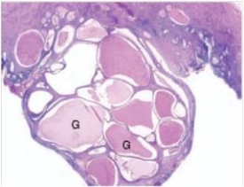 <strong>A 41 year old woman consulted her GP because of abnormal bleeding in between menstrual periods.Examination disclosed a mass visible at the cervical os.An excisional biopsy was performed,and a representative section is shown in the accompanying photomicrograph.Which one of the following is the best diagnosis? </strong> A)Endocervical polyp B)Endometriosis C)Human papilloma virus infection (HPV) D)Herpes simplex virus infection E)Severe dysplasia/carcinoma in situ