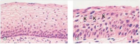 <strong>A 22 year old woman was seen by her GP for follow-up after an abnormal Pap smear.A biopsy of the cervix was done,and a representative section is shown in the accompanying photomicrograph.Which one of the following is the best diagnosis? </strong> A)Endocervical polyp B)Endometriosis C)Human papilloma virus infection (HPV) D)Herpes simplex virus infection E)Severe dysplasia/carcinoma in situ